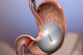 Mide balonu yan etkileri nelerdir?